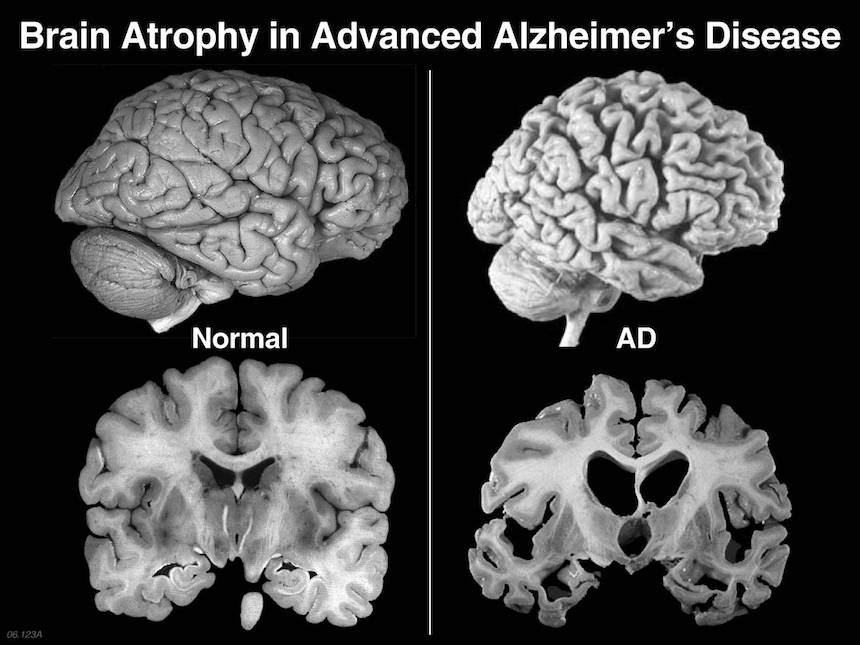 U.S. Death Rates from Alzheimer’s Disease Increased 55 Percent from 1999 to 2014