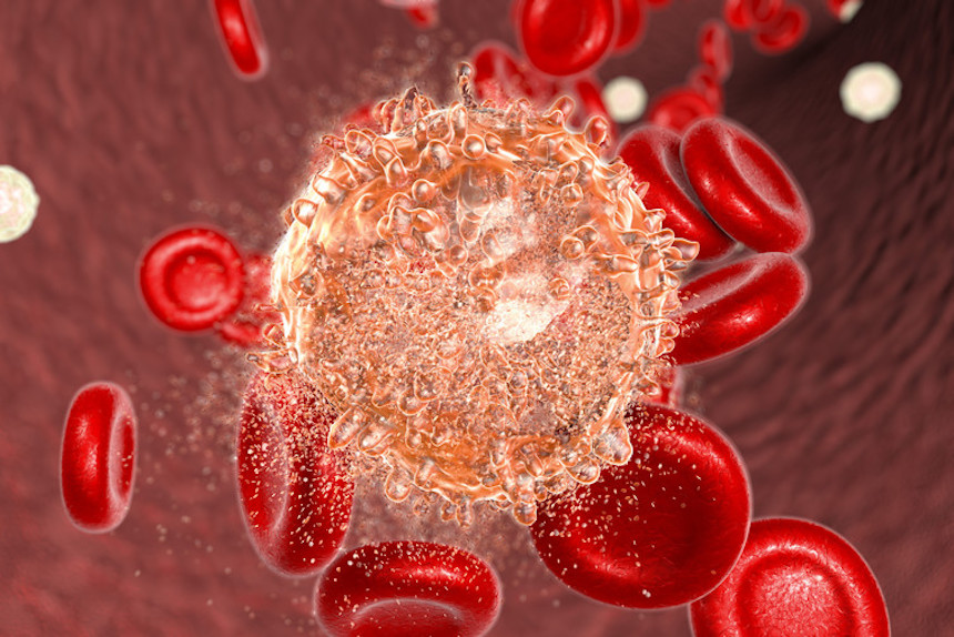 Kenyan Study Shines New Light on Chronic Myeloid Leukemia