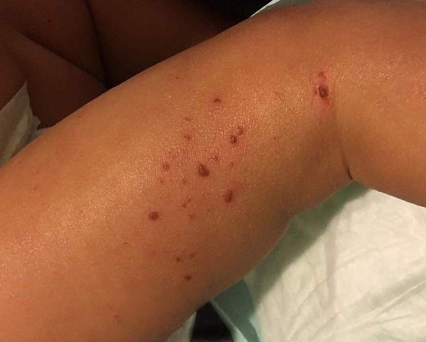 Scientists Identify Single-Gene Mutations That Lead to Atopic Dermatitis