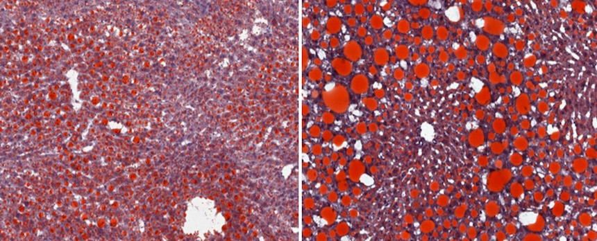NIH Study Sheds Light on Immune Responses Driving Obesity-Induced Liver Disease