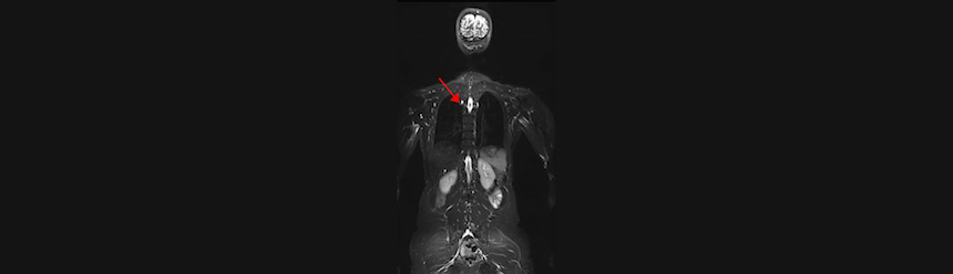 NCI Study Shows Feasibility of Cancer Screening Protocol for Patients with Li-Fraumeni Syndrome