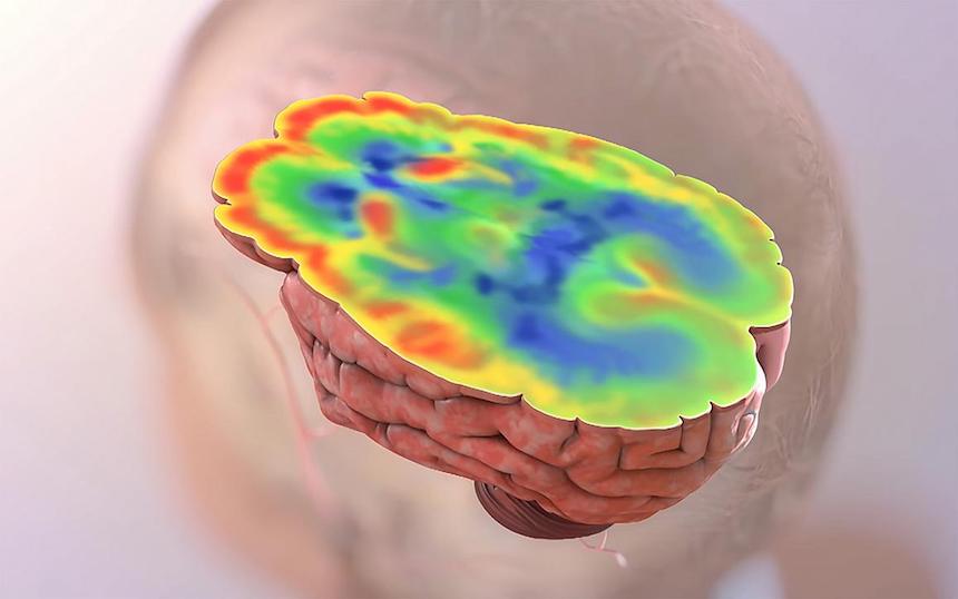 Higher Brain Glucose Levels May Mean More Severe Alzheimer’s
