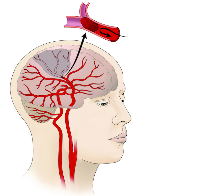 Hibernating Ground Squirrels Provide Clues to New Stroke Treatments