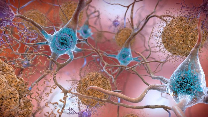 BRIEF: New Forecast Shows 6 Million with Alzheimer’s Disease, Cognitive Impairment