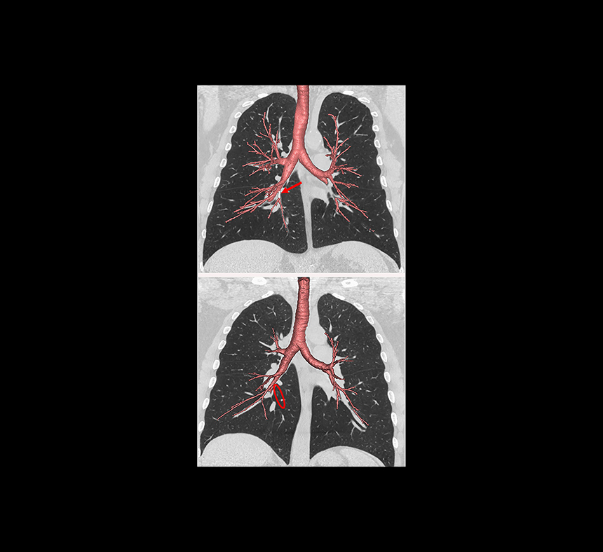 New Study Offers Insights on Genetic Indicators of COPD Risk