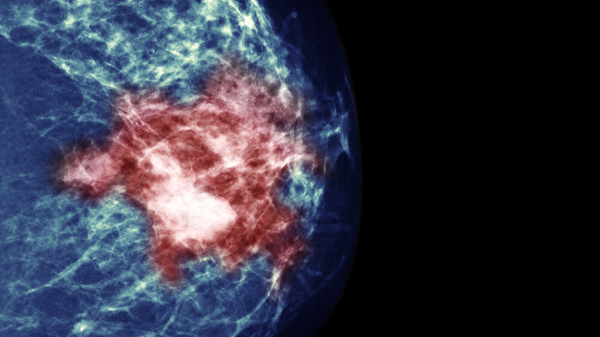 Neoadjuvant Chemotherapy in Breast Cancer: More Than Just Downsizing