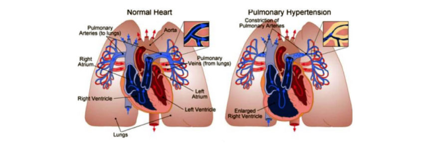 Johns Hopkins Investigators Unravel Biological Roots of Pulmonary Hypertension