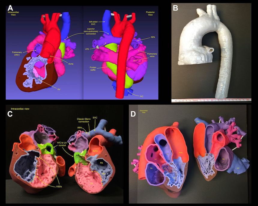 3-D Printing Is Transforming Care for Congenital Heart Disease
